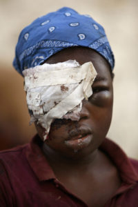 An earthquake survivor sits with part of her face covered by a bandage in Port-au-Prince, Haiti, Thursday, Jan. 14, 2010.  A 7.0-magnitude earthquake struck Haiti Tuesday. (AP Photo/Ricardo Arduengo) XRA103